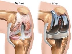 Total Knee Replacement In New Delhi